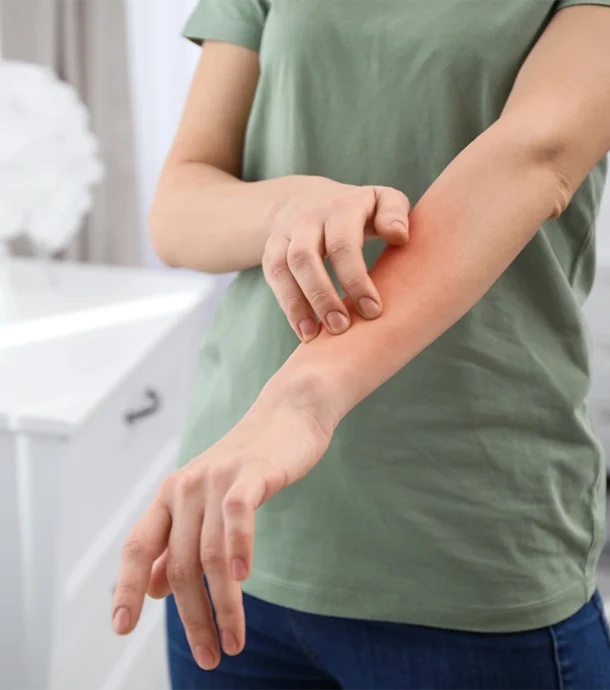 Causes of Hives