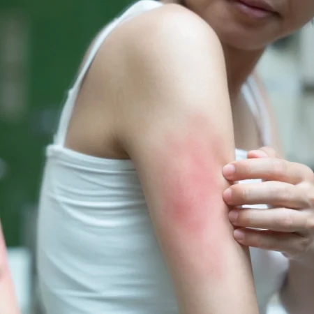 Environmental Injuries – Minor Burns Environmental Injuries - Minor Burns