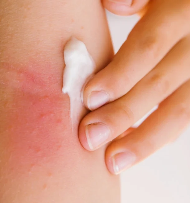 Heat Happens_ Recognizing and Treating Minor Environmental Burns Heat Happens_ Recognizing and Treating Minor Environmental Burns