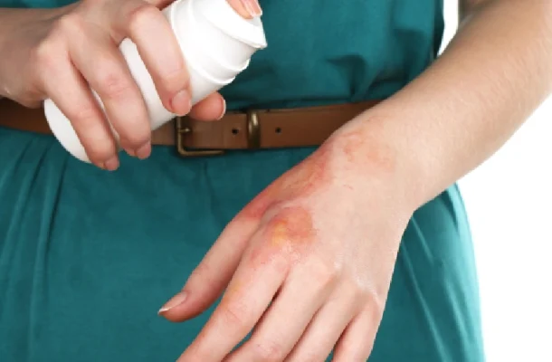 Itchy Encounters_ Identifying and Treating Poison Ivy and Plant Dermatitis Itchy Encounters_ Identifying and Treating Poison Ivy and Plant Dermatitis