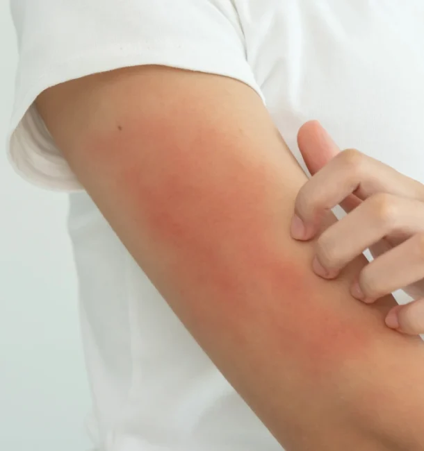 Minor Burns – Overview Minor Burns - Overview