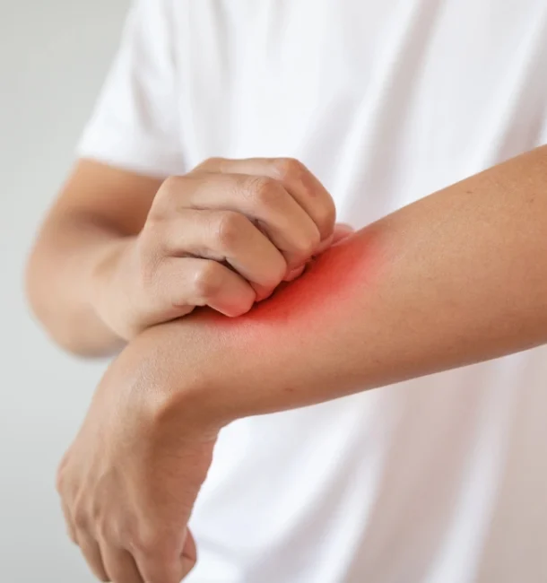 Symptoms of Plant Dermatitis from Poison Ivy Symptoms of Plant Dermatitis from Poison Ivy