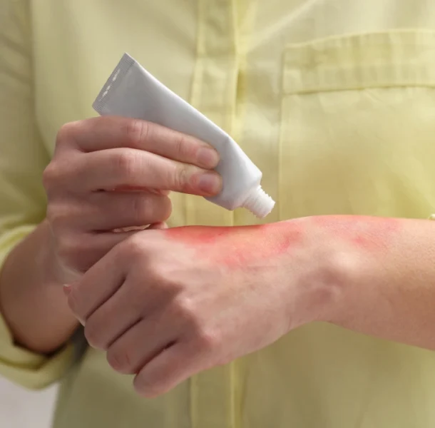 Treatment Options for Poison Ivy Dermatitis Treatment Options for Poison Ivy Dermatitis