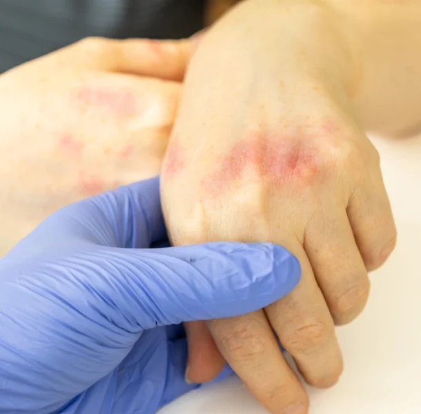 Understanding Poison Ivy and Other Culprits Understanding Poison Ivy and Other Culprits